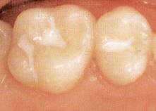 Okklusalfläche von zwei Zähnen mit Fissurenversiegelung